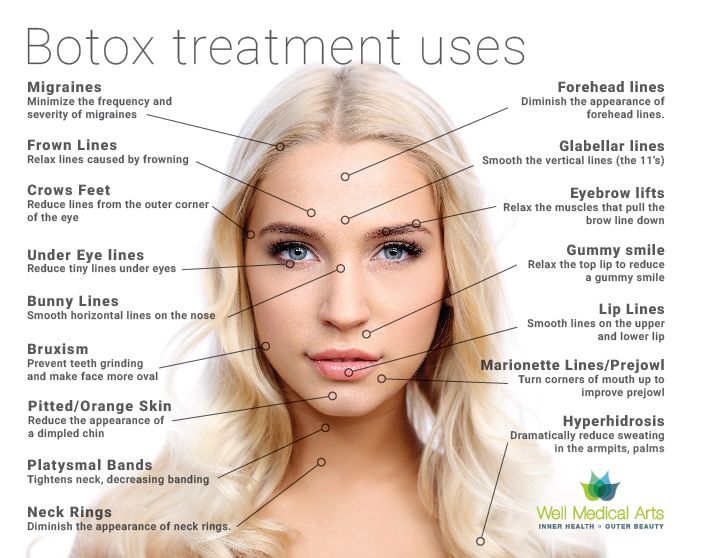 Botox behandlinger